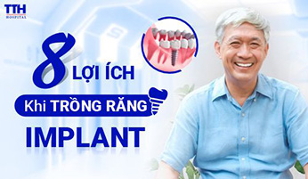 8 lợi ích khi trồng răng implant bạn nên biết