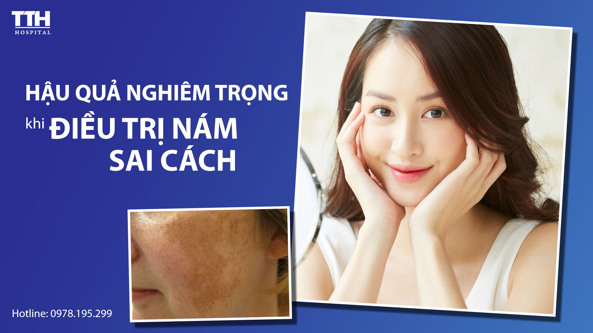 Điều trị nám sai cách để lại những hậu quả nghiêm trọng
