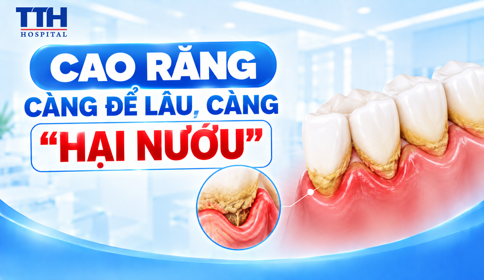 CAO RĂNG CÀNG ĐỂ LÂU, CÀNG “HẠI NƯỚU”