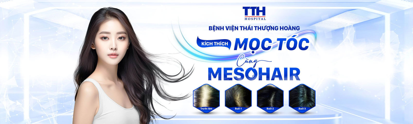 Kích Thích Mọc Tóc Bằng Mesotherapy: Phương Pháp Hiệu Quả Cho Mái Tóc Dày Mượt