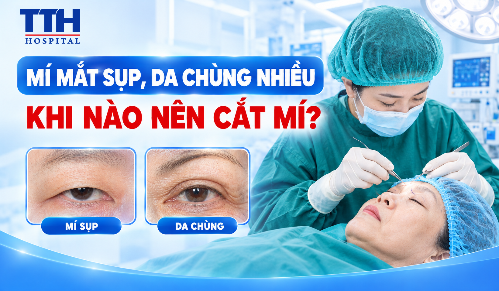MÍ MẮT SỤP, DA CHÙNG NHIỀU: KHI NÀO NÊN CẮT MÍ?