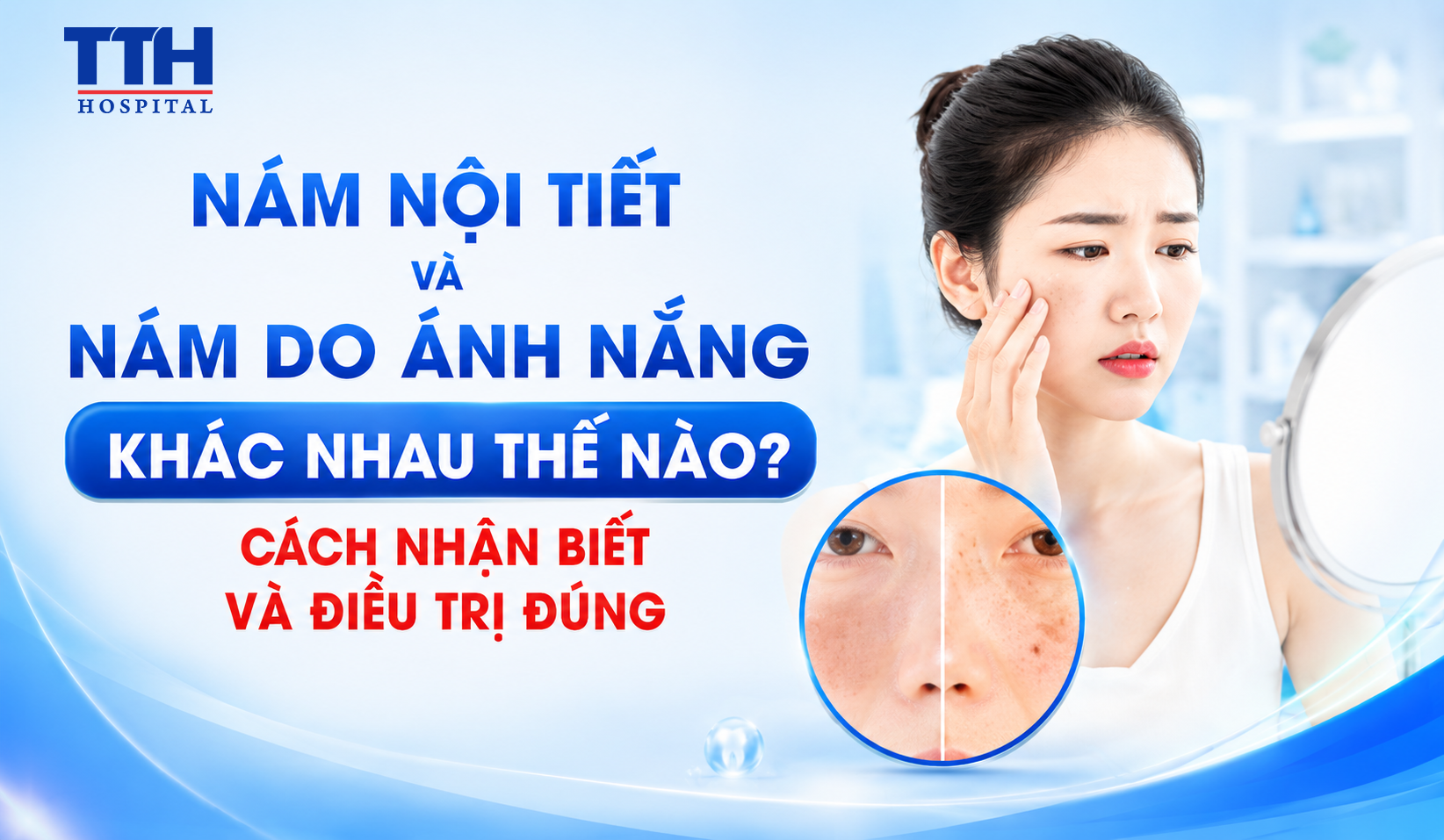 NÁM NỘI TIẾT VÀ NÁM DO ÁNH NẮNG KHÁC NHAU THẾ NÀO? CÁCH NHẬN BIẾT VÀ ĐIỀU TRỊ ĐÚNG