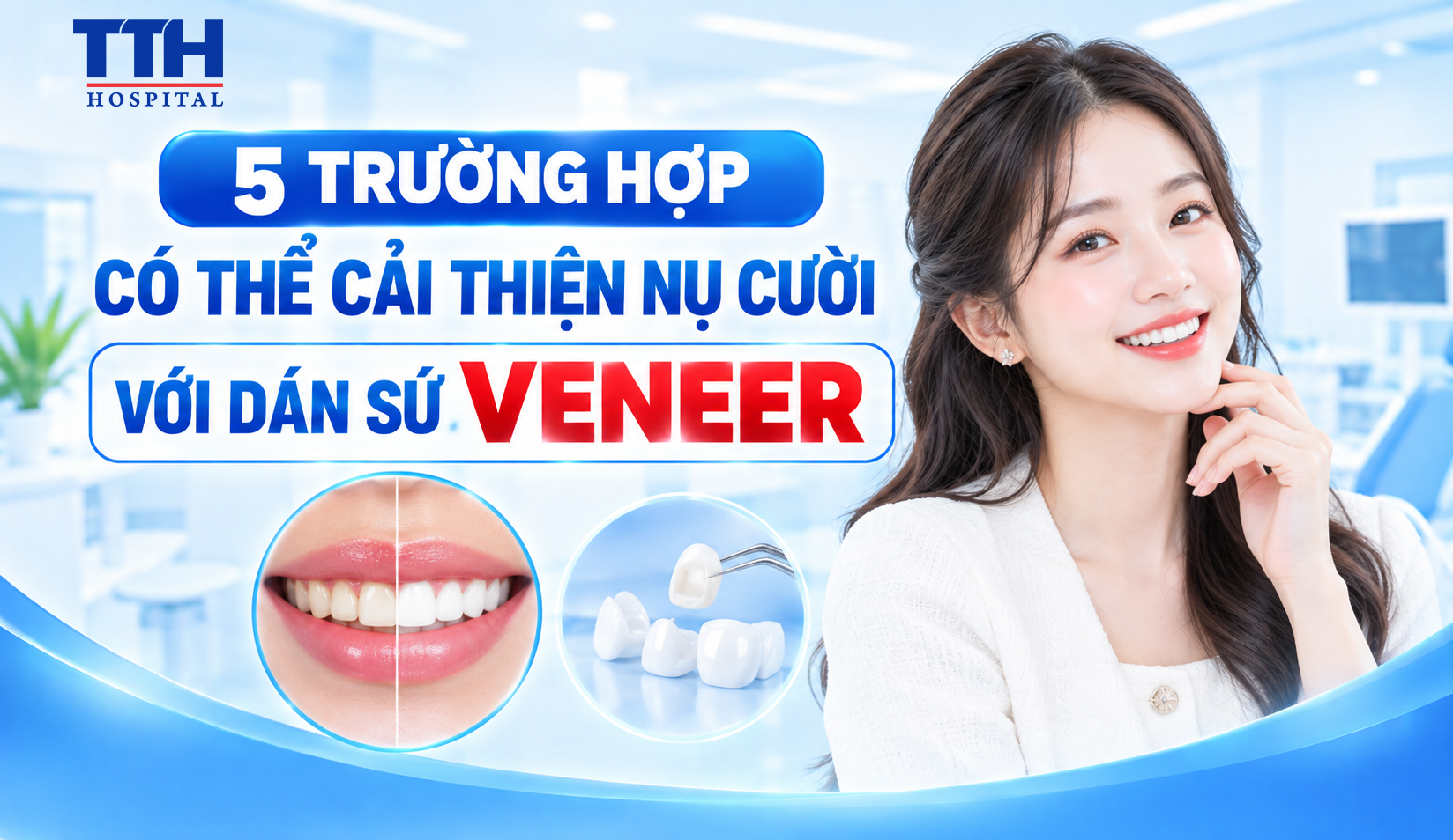 5 TRƯỜNG HỢP CÓ THỂ CẢI THIỆN NỤ CƯỜI VỚI DÁN SỨ VENEER