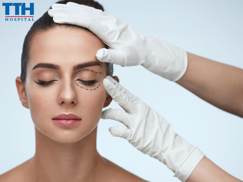 Nên Cắt Mí Perfect Eyes Hay Mini Deep?