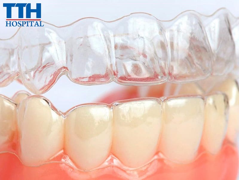 Niềng răng trong suốt có hiệu quả không?
