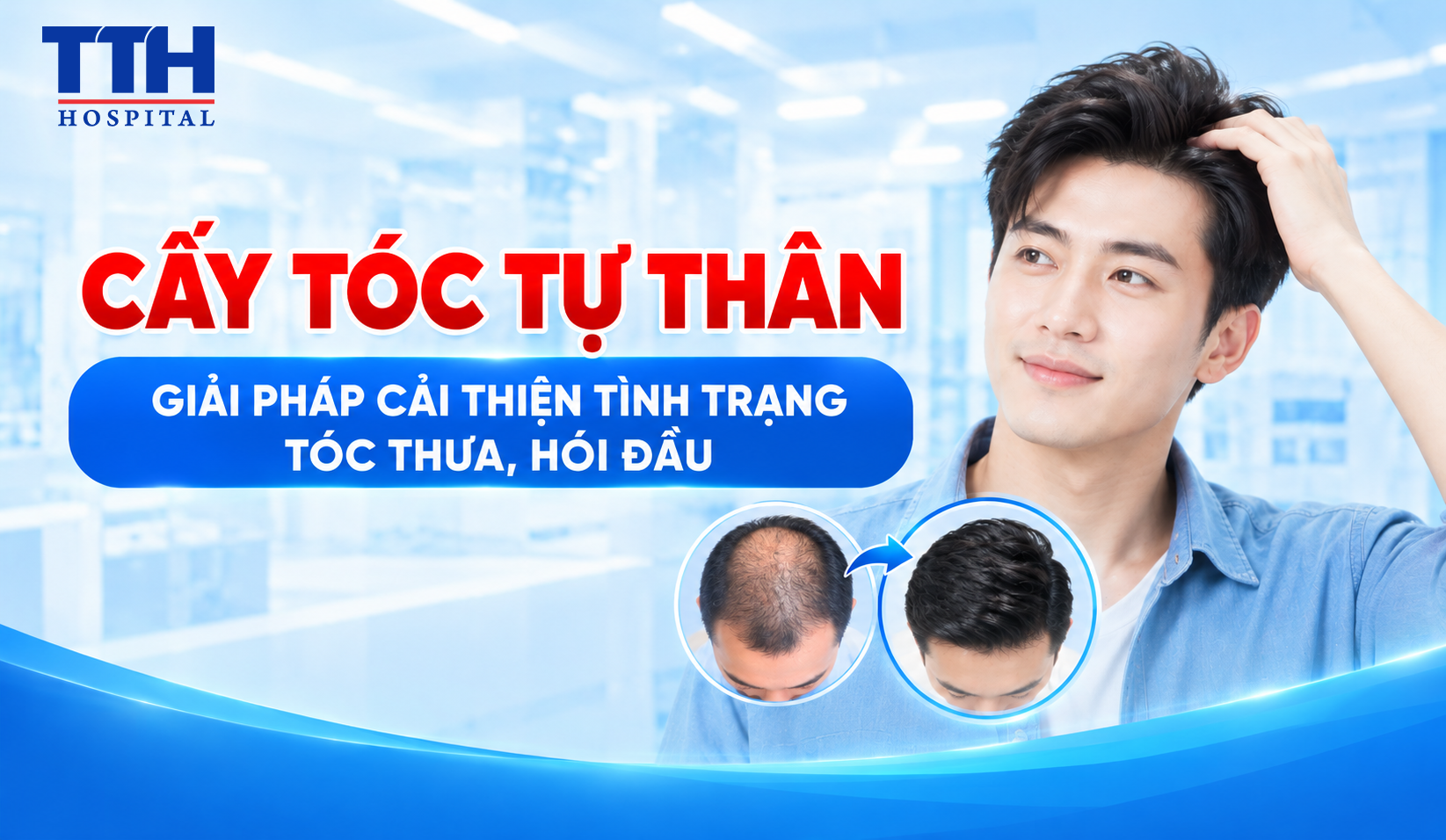 CẤY TÓC TỰ THÂN - GIẢI PHÁP CẢI THIỆN TÌNH TRẠNG TÓC THƯA, HÓI ĐẦU