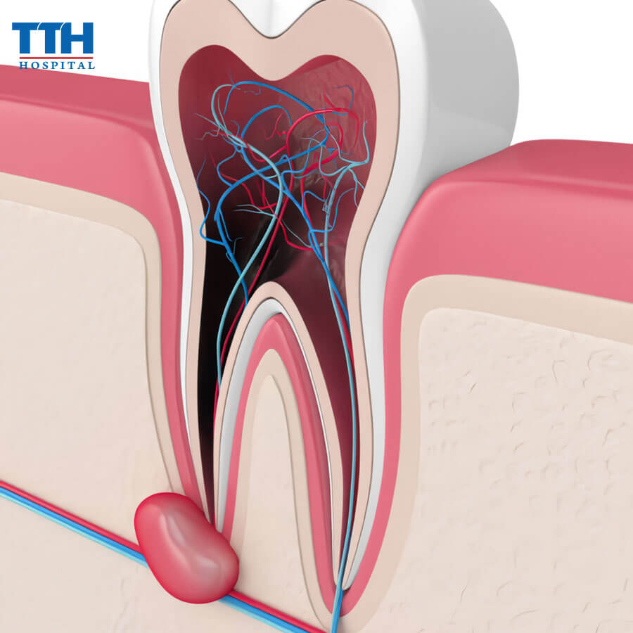 Áp Xe Tủy Răng Là Gì?