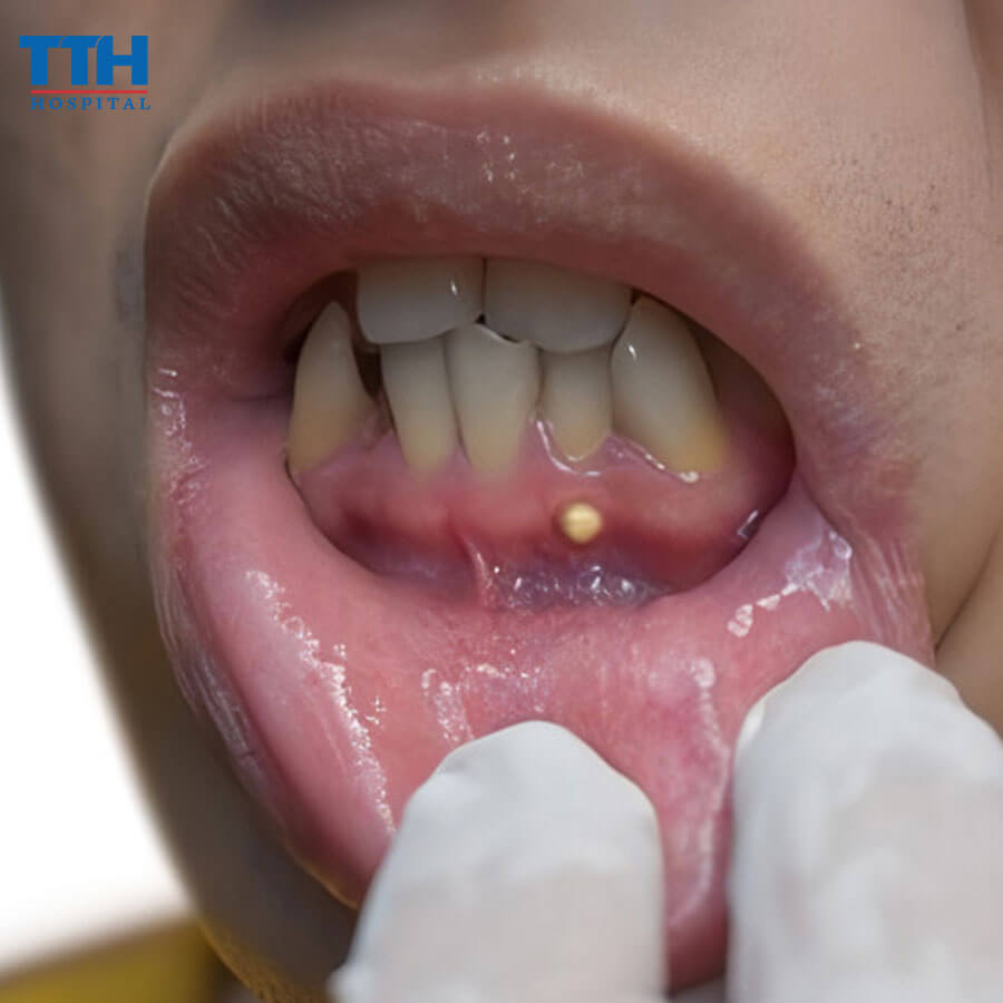 Áp Xe Tủy Răng: Nguyên Nhân, Triệu Chứng và Điều Trị