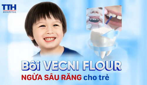 Bôi Vecni Fluor ngừa sâu răng cho trẻ