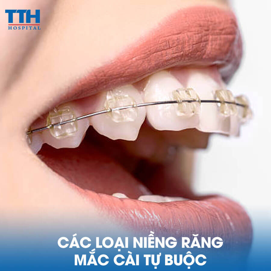 Các Loại Niềng Răng Mắc Cài Tự Buộc