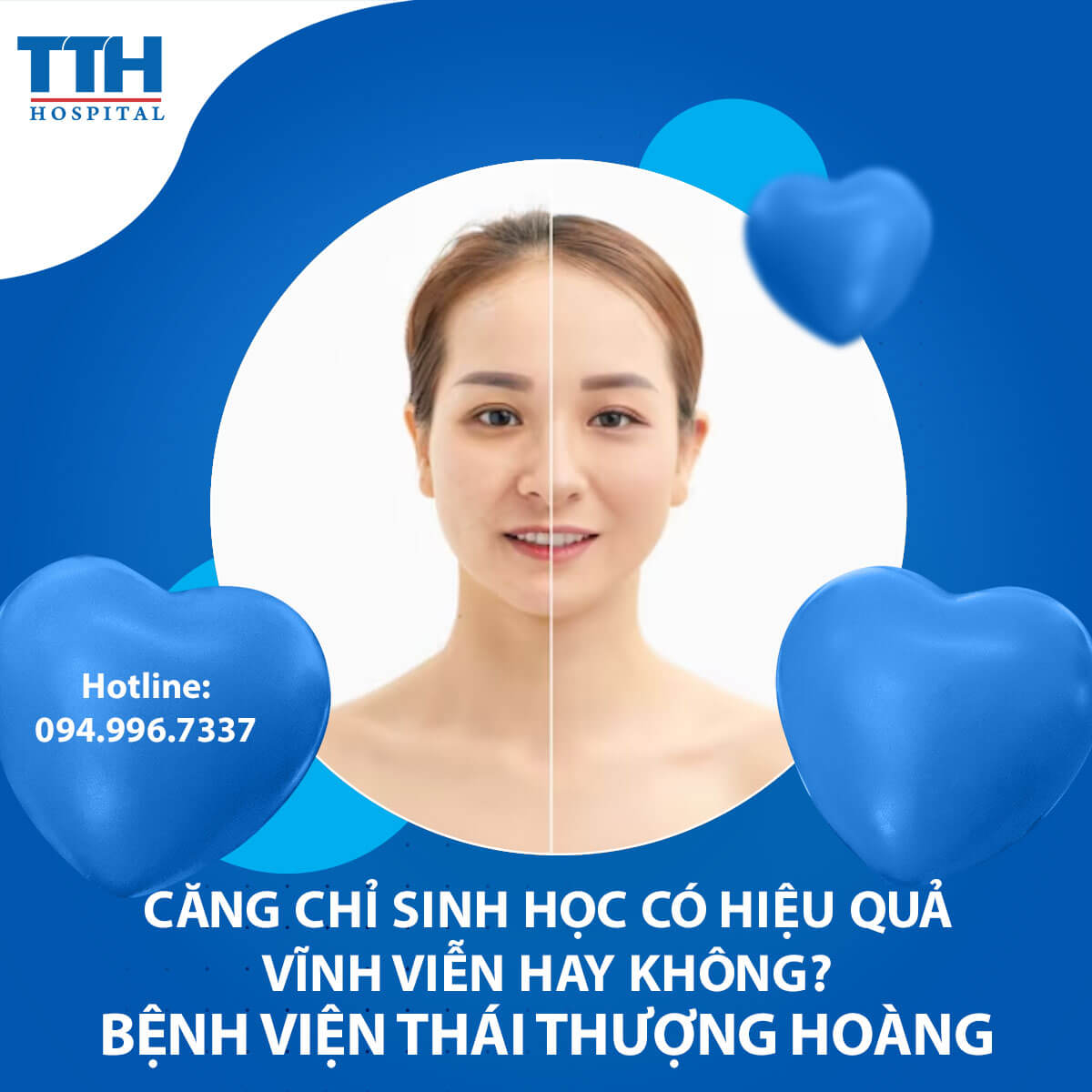 Căng chỉ sinh học có hiệu quả vĩnh viễn hay không?