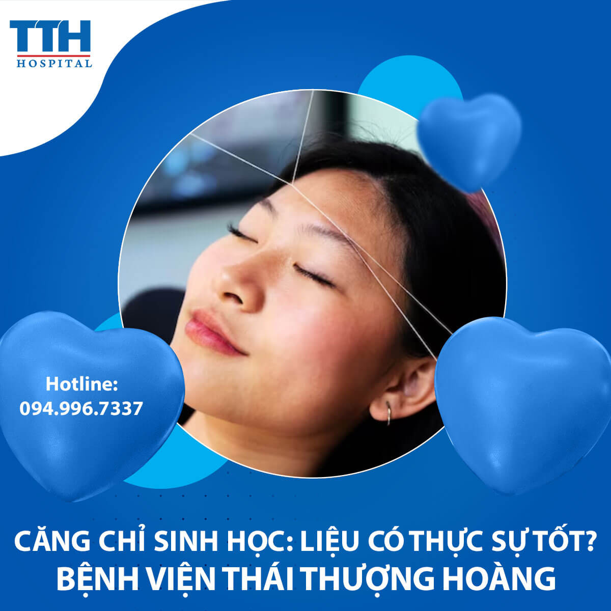 Căng chỉ sinh học: Liệu có thực sự tốt?
