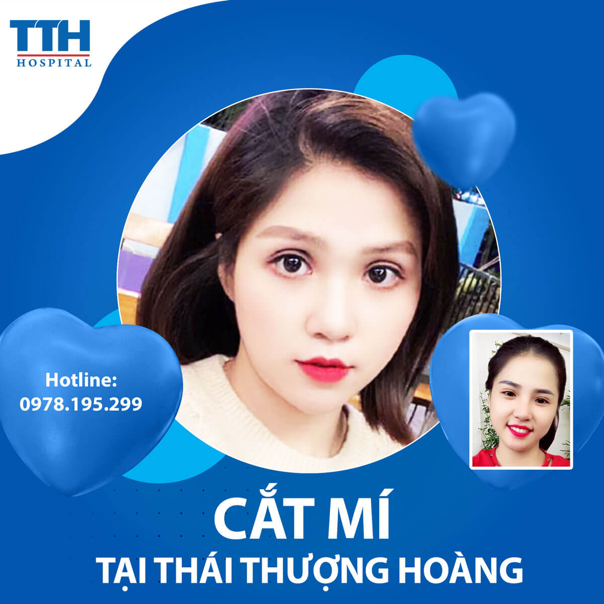 Cắt Mí Mắt - Thông Tin Cần Biết Trước Phẫu Thuật
