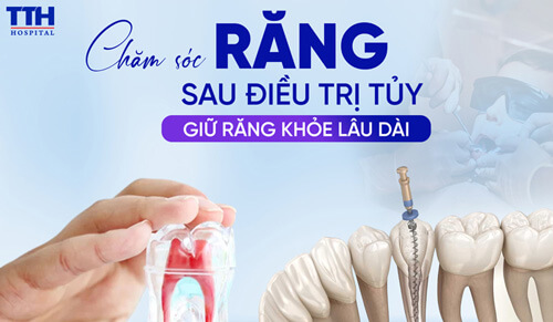 CHĂM SÓC RĂNG SAU ĐIỀU TRỊ TỦY – GIỮ RĂNG KHỎE LÂU DÀI