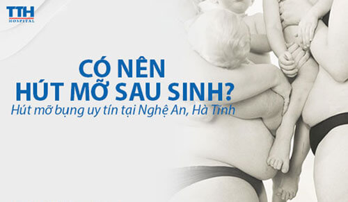 Có nên hút mỡ bụng sau sinh? Hút mỡ bụng uy tín tại Nghệ An, Hà Tĩnh