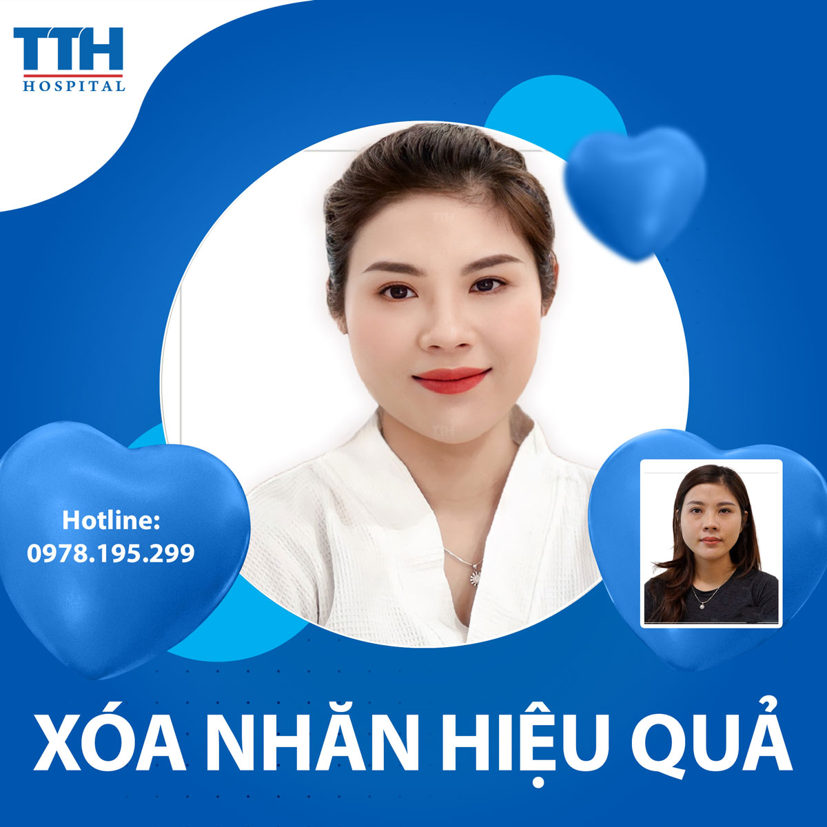 Địa chỉ xóa da nhăn uy tín tại Vinh - Bệnh viện Thái Thượng Hoàng