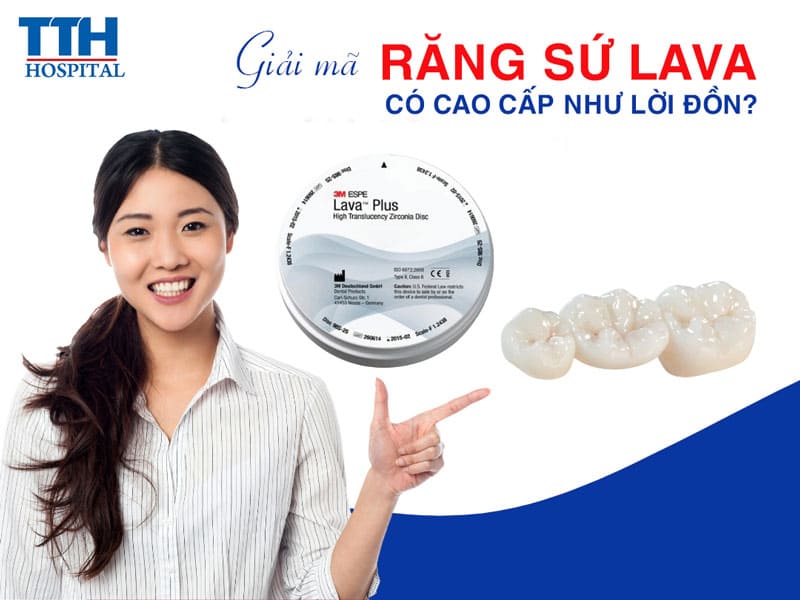 Giải mã "Răng sứ Lava có thực sự cao cấp như lời đồn”?