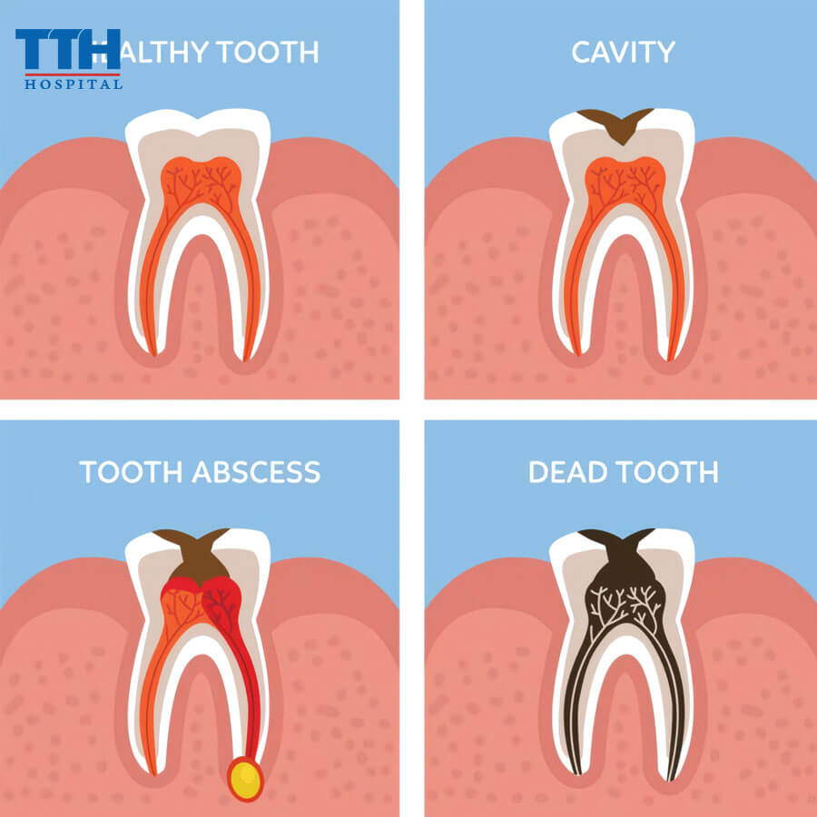 Hoại Tử Tủy Răng Có Nguy Hiểm Không?