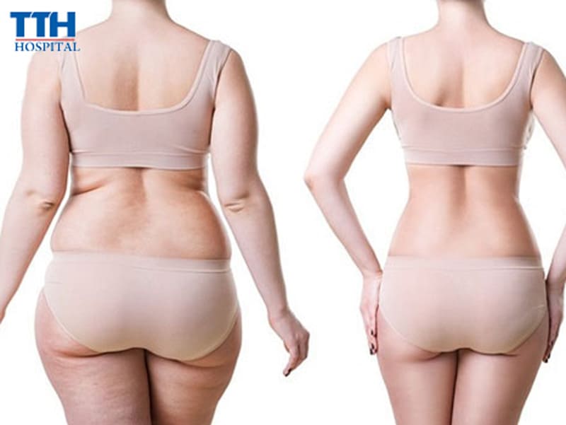Hút mỡ toàn thân có an toàn không?
