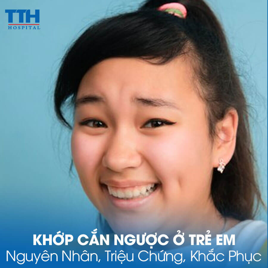 Khớp Cắn Ngược ở Trẻ Em: Nguyên Nhân, Triệu Chứng và Cách Khắc Phục