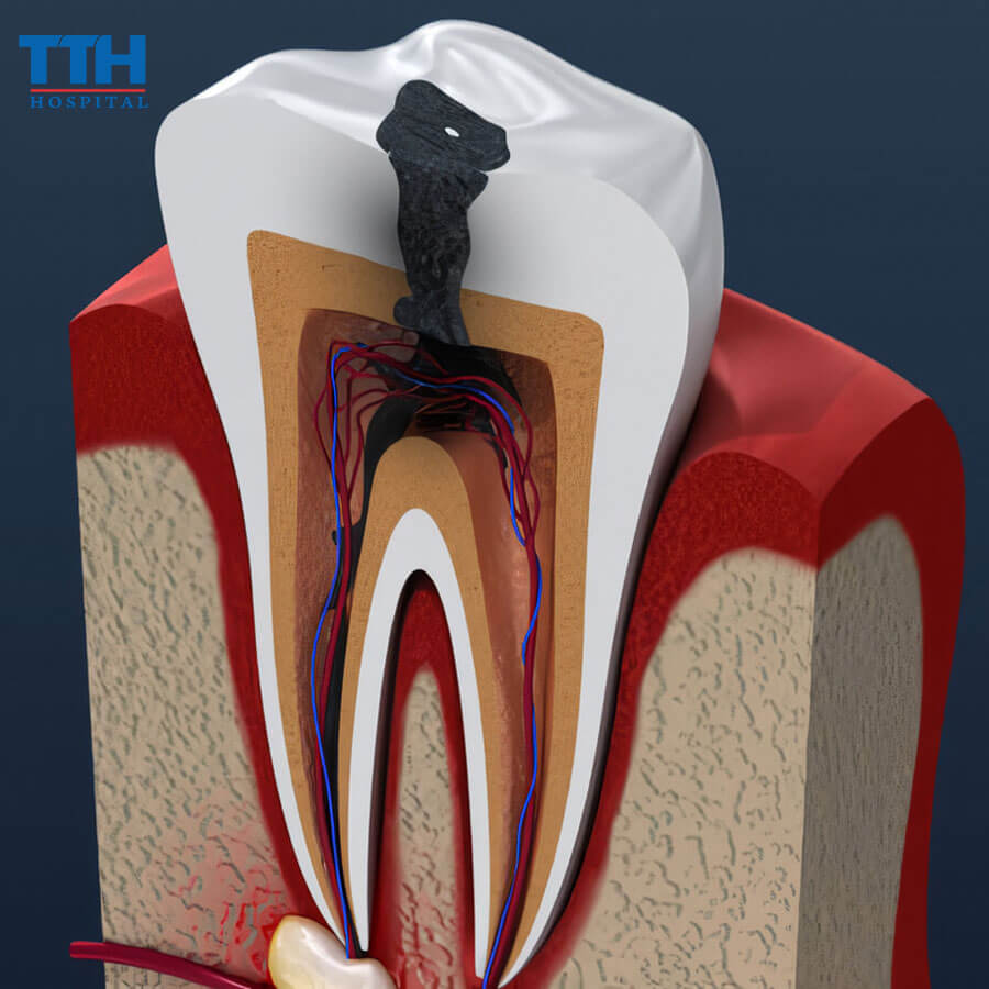 Lưu Ý Khi Điều Trị Tủy Răng?
