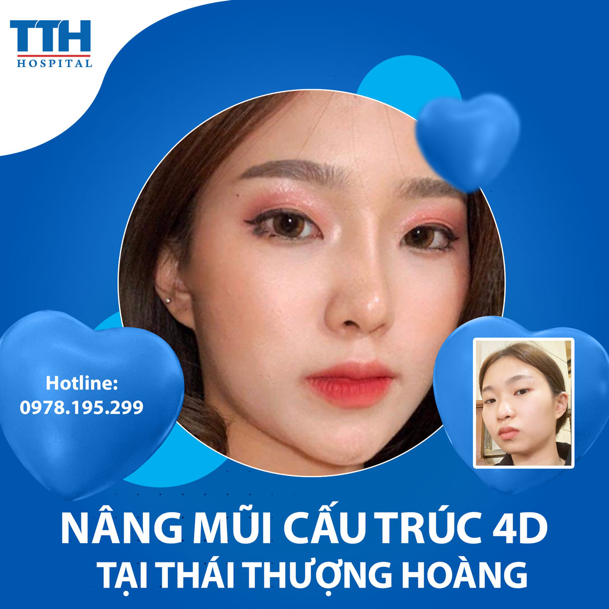 Nâng mũi cấu trúc 4D: Đạt được vẻ đẹp tự nhiên và hài hòa
