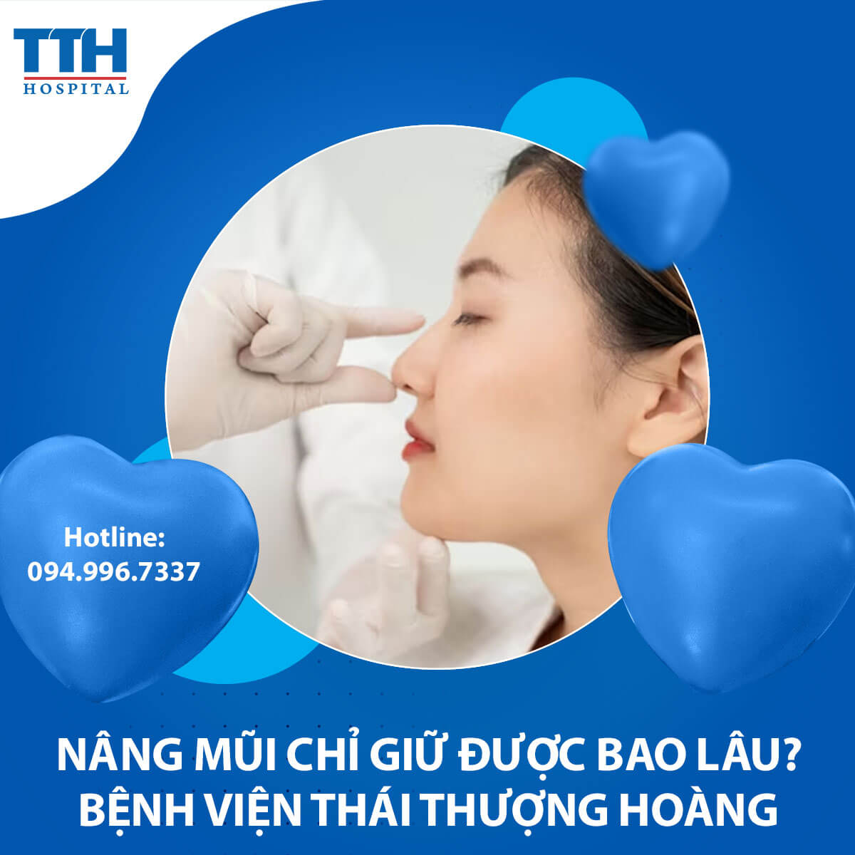 Nâng Mũi Chỉ Giữ Được Bao Lâu?