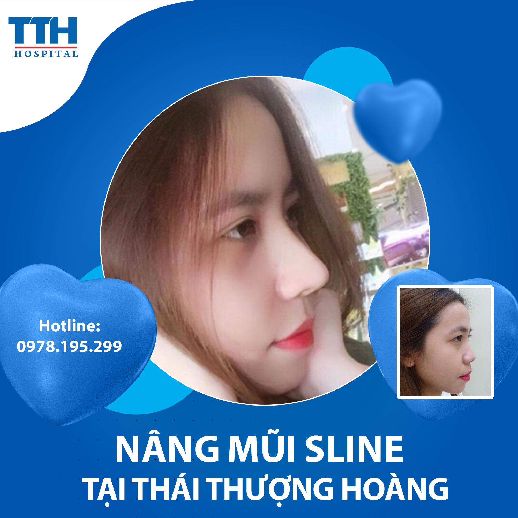 Nâng mũi Sline - Giải pháp hoàn hảo cho một gương mặt đẹp tự nhiên
