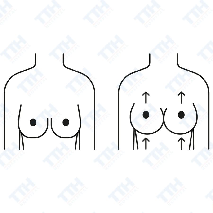 Nâng ngực chảy xệ: Sự khác nhau giữa có và không đặt túi