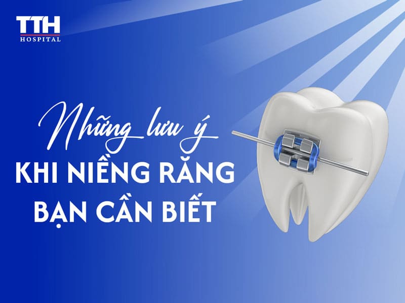 Niềng Răng Là Gì? Các Lưu Ý Khi Niềng Răng Mà Bạn Cần Biết