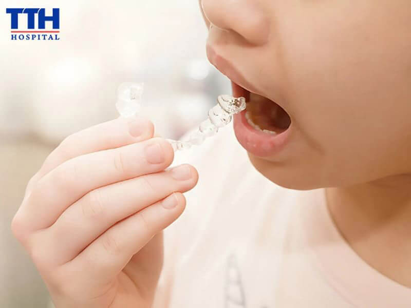 Niềng răng trong suốt cho trẻ em: Độ tuổi thích hợp và những điều cần lưu ý