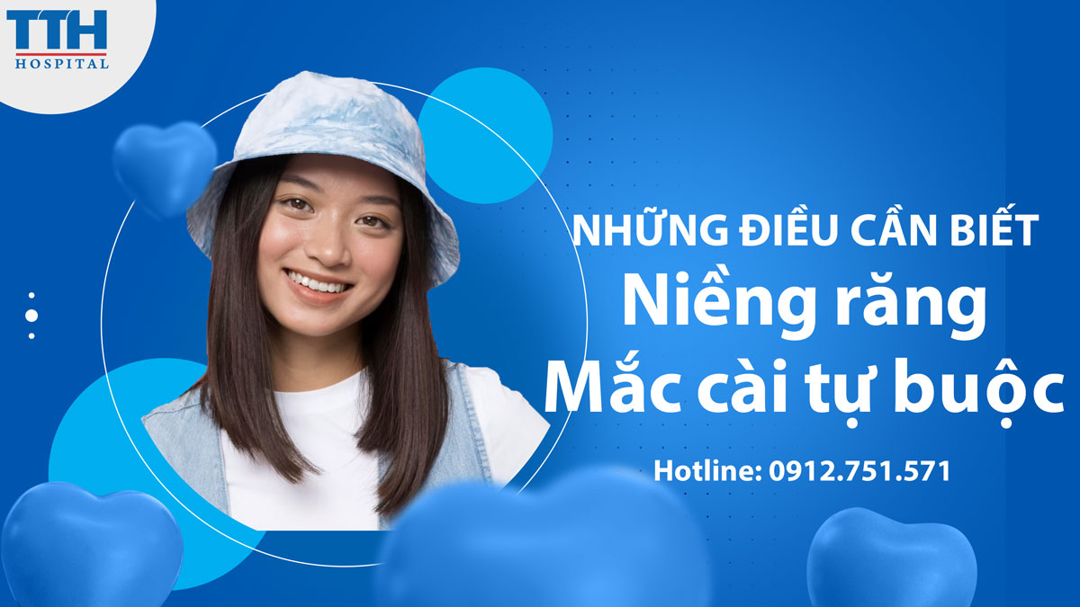Niềng răng mắc cài tự buộc: Những điều cần biết