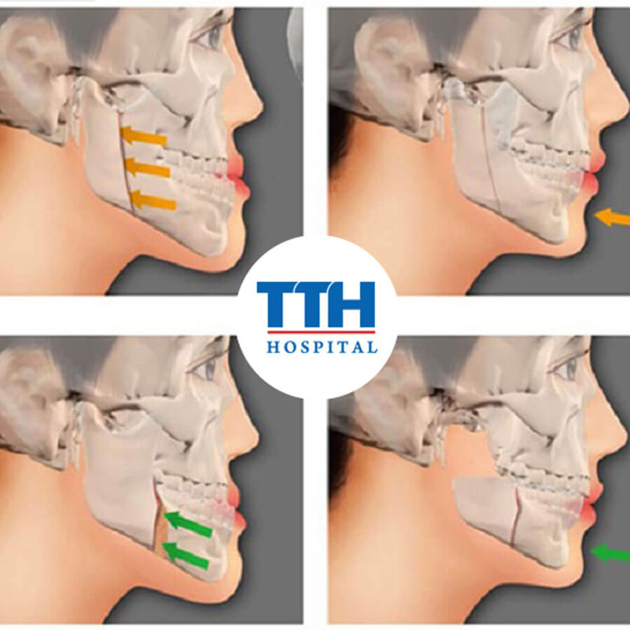 Phẫu thuật hàm mặt