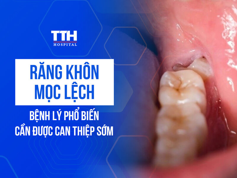 RĂNG KHÔN MỌC LỆCH: BỆNH LÝ PHỔ BIẾN CẦN ĐƯỢC CAN THIỆP SỚM 
