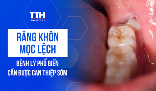 RĂNG KHÔN MỌC LỆCH: BỆNH LÝ PHỔ BIẾN CẦN ĐƯỢC CAN THIỆP SỚM 