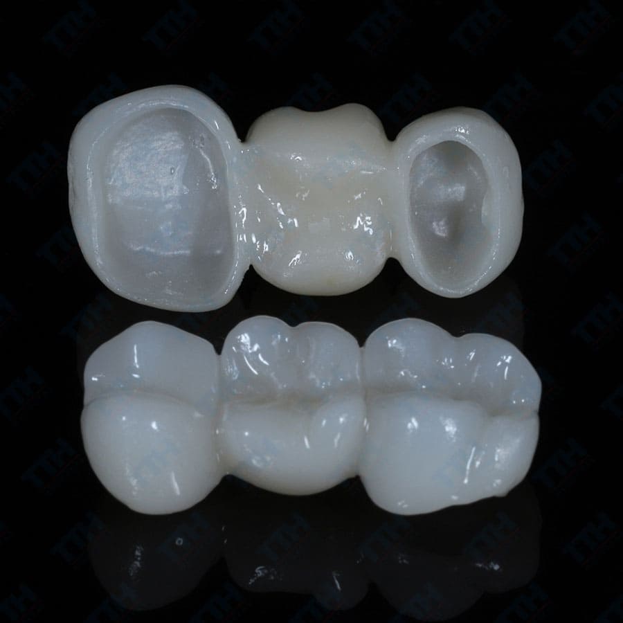 Răng sứ Orodent là gì? Tìm hiểu từ A đến Z về dòng răng sứ cao cấp này