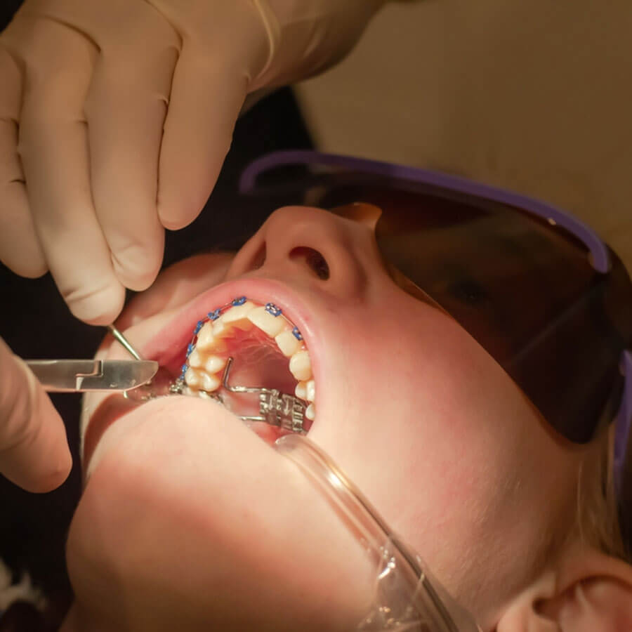 Tháo Niềng Răng Có Đau Không?