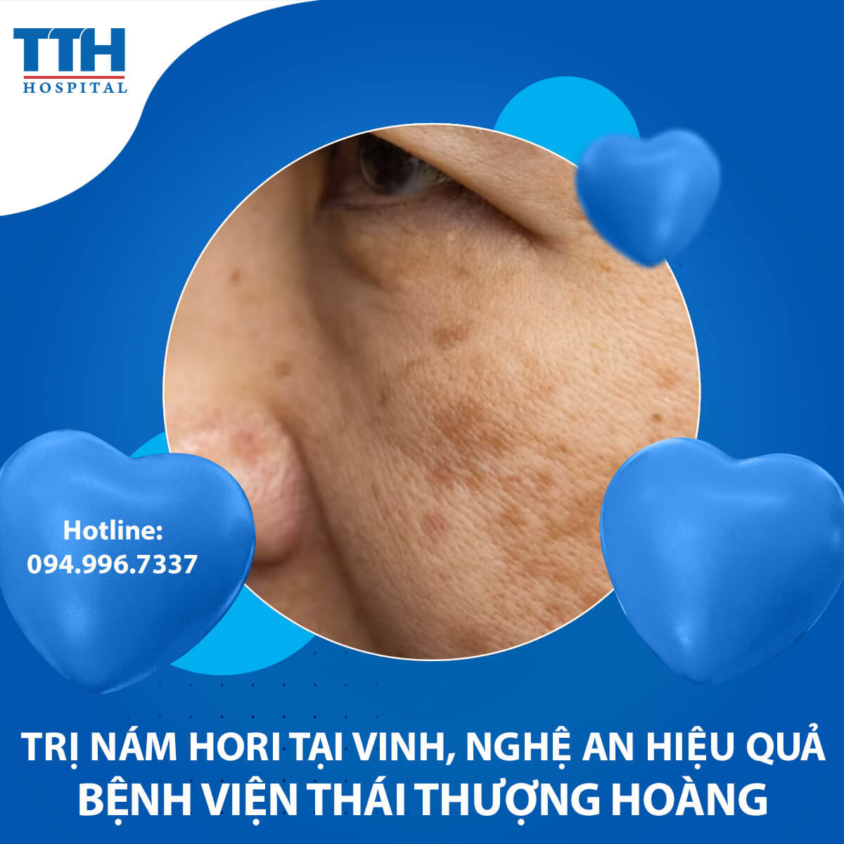 Trị Nám Hori Tại Vinh, Nghệ An Hiệu Quả