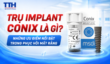 TRỤ IMPLANT CONIX LÀ GÌ? NHỮNG ƯU ĐIỂM NỔI BẬT TRONG PHỤC HỒI MẤT RĂNG