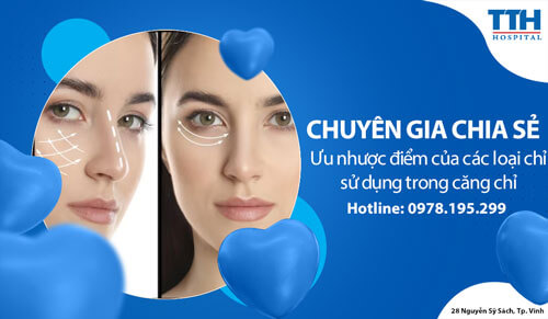 Ưu nhược điểm của các loại chỉ sử dụng trong căng chỉ