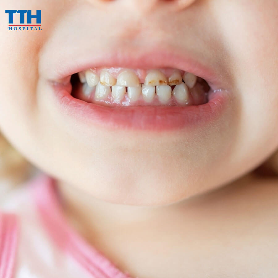 Vecni Fluor Là Gì? 