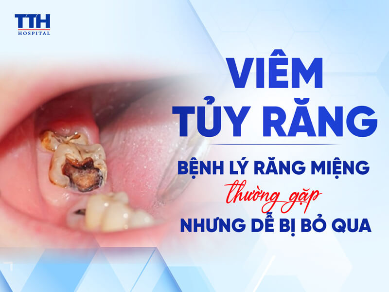 Viêm tủy răng – Bệnh lý răng miệng thường gặp nhưng dễ bị bỏ qua