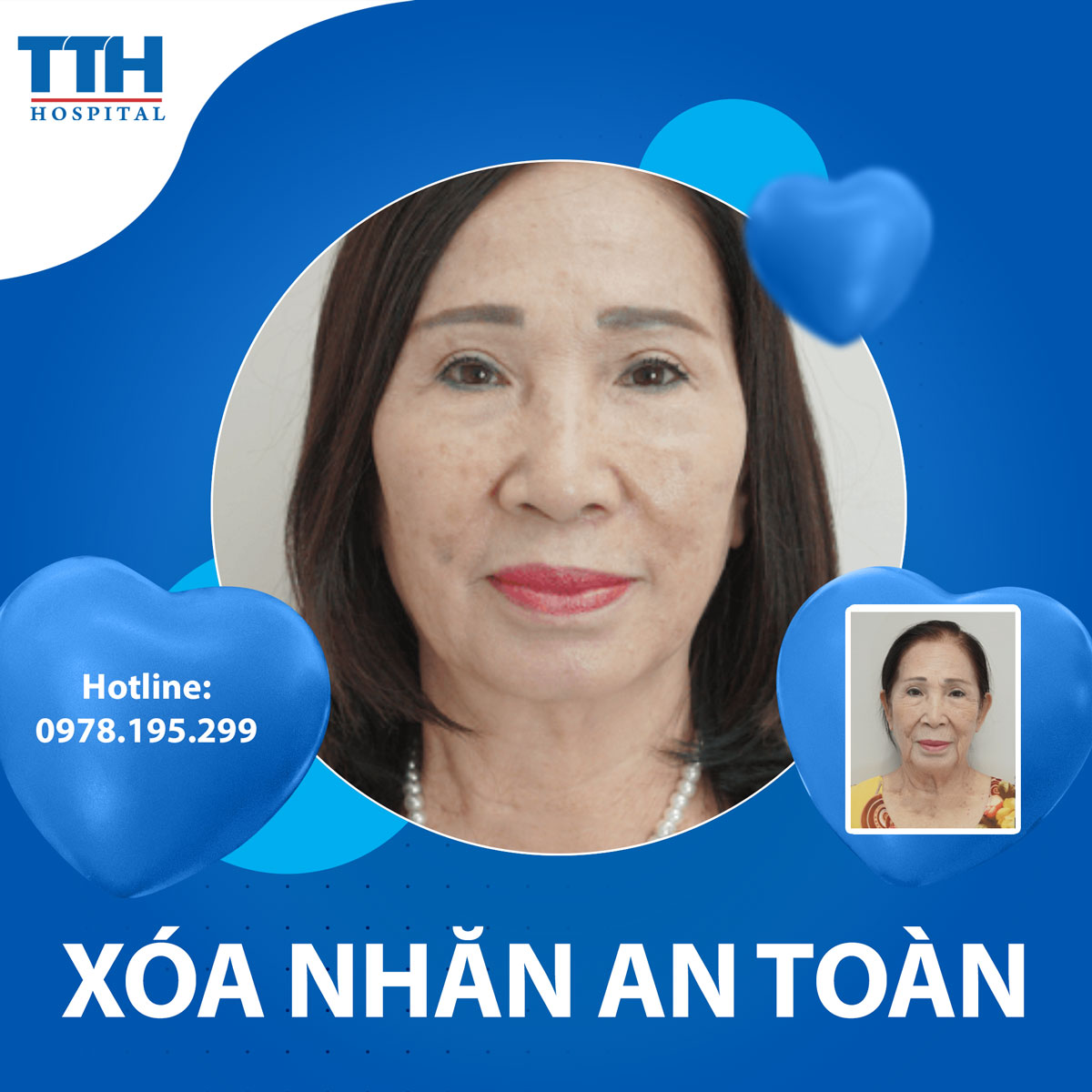 Xóa da nhăn an toàn - Điều trị da hiệu quả và tự tin hơn